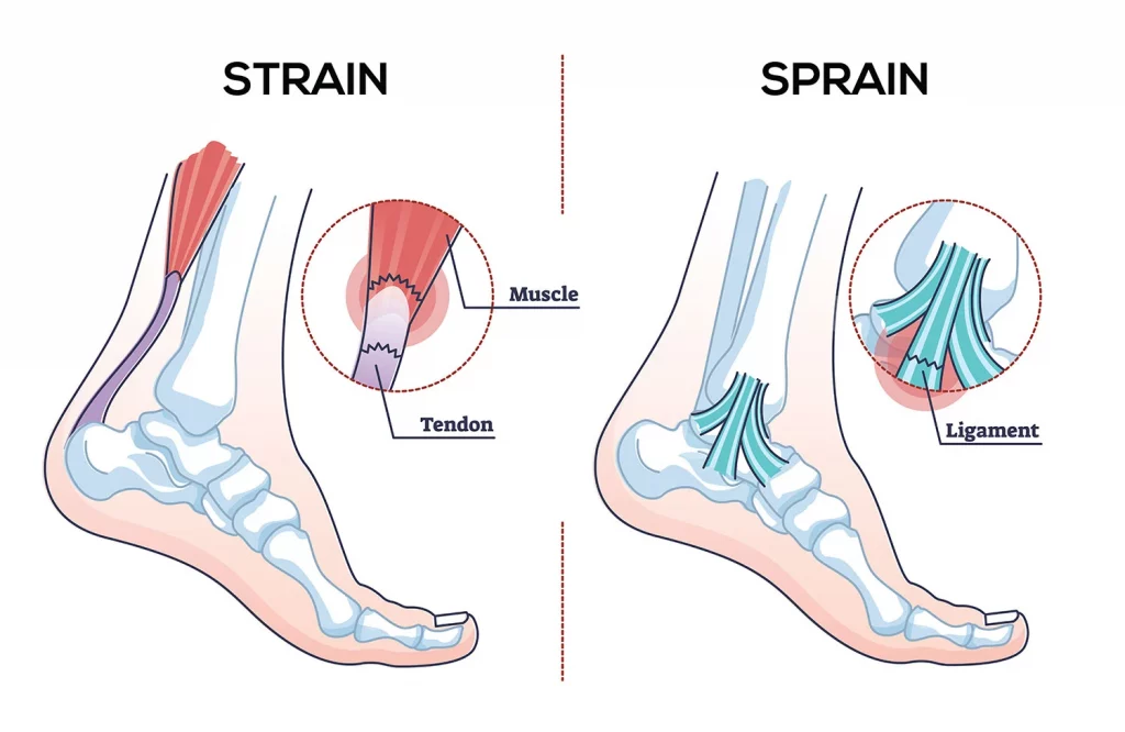Strain ou Sprain